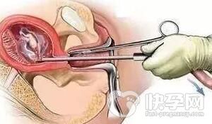 宫腔粘连严重必须手术治疗吗做试管多少钱？