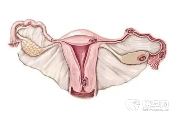 有子宫腺肌症做试管选男女成功率高吗？