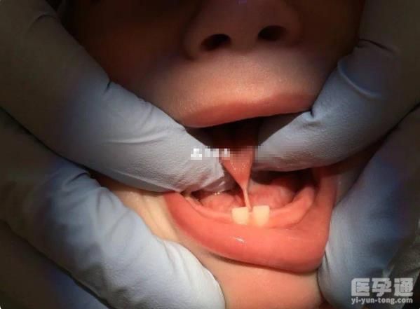 不要轻易给孩子剪掉舌系带！等你发现危害就来不及了！