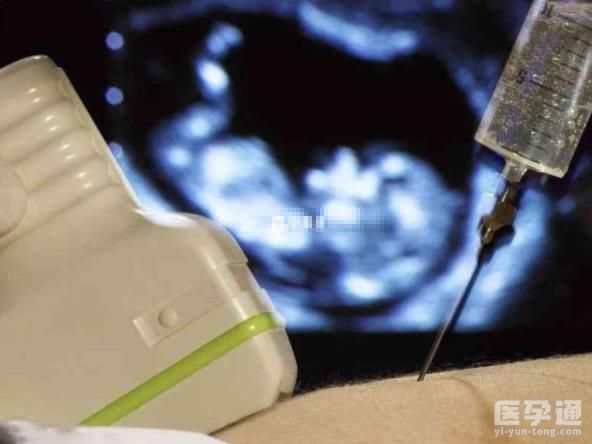 妇科熟人都不说羊穿是必做项目，这几种风险你得提前了解！