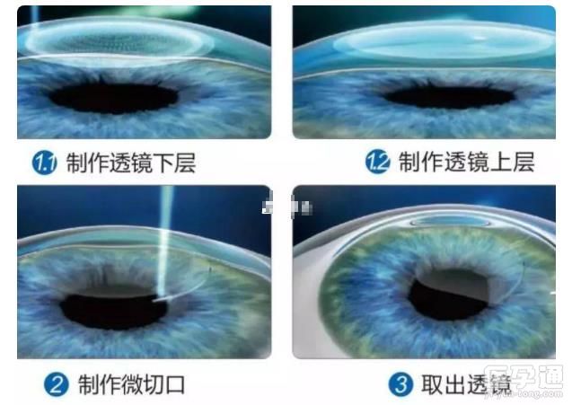 近视手术并非所有人都能做！医生：术后副作用得提前了解！