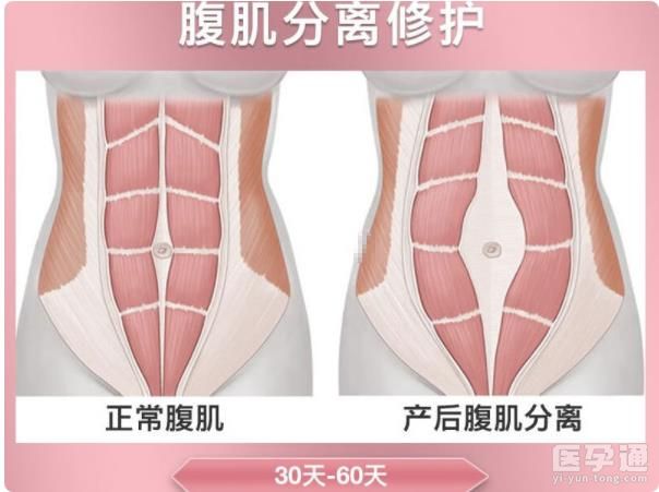 医生为你揭秘产后腹直肌修复真相，适当运动锻炼即可恢复！