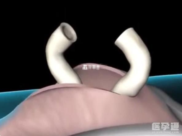 男性结扎有什么副作用？医生不建议这样做的原因找到了！