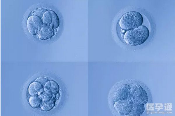 小睑裂综合征天生小眼睛要遗传，三代试管婴儿助孕优生！