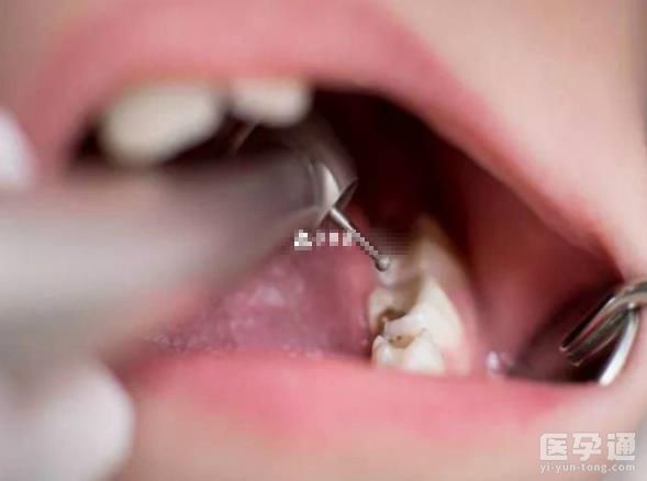 医生不建议给婴儿清洁口腔原因分析，引发疾病不是没可能！