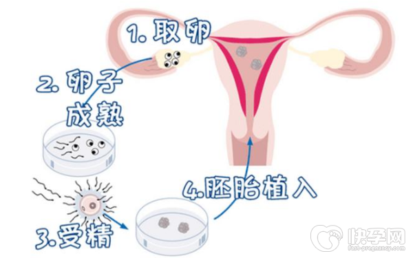 2023珠海市妇幼赠卵生儿子费用多少？附三代试管赠卵条件