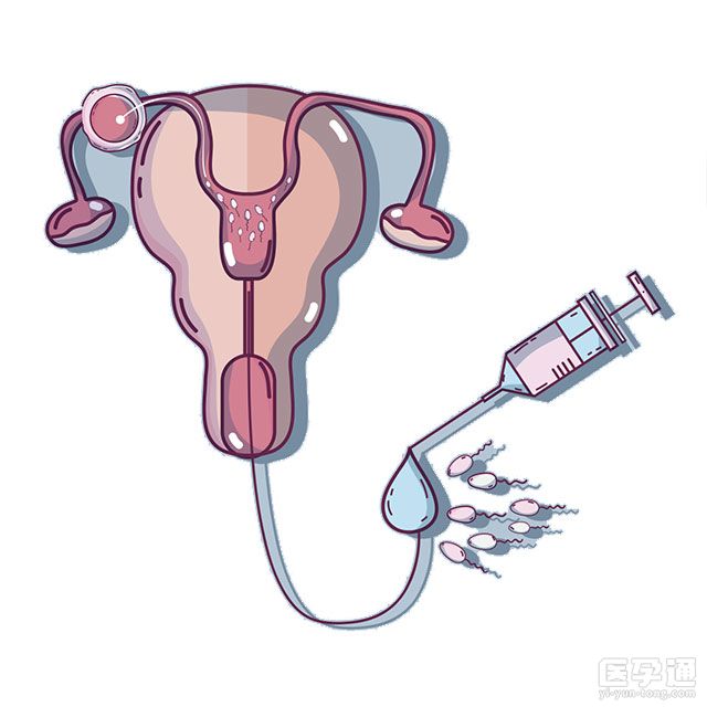 子宫内膜息肉能做试管婴儿吗？试管之前需要治疗吗？