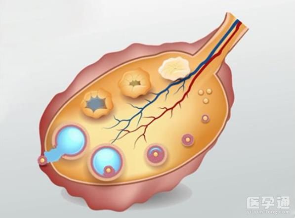 畸胎瘤导致不排卵别慌张，仅需一招就能轻松怀孕！