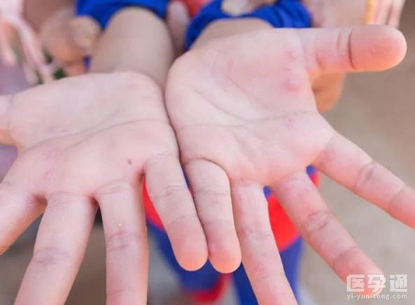 揭秘接种手足口疫苗必要性，“没必要打”背后是骗*！