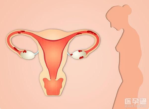 绝经后阴干可以通过涂抹雌激素软膏来改善吗？