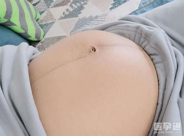 妊娠线看胎儿性别，上细下粗分辨男女真的很准！