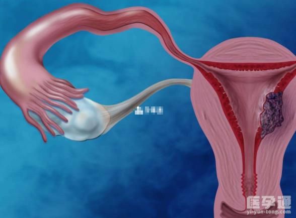 揭晓为什么十个宫腔镜九个内膜炎，和医生操作手法有关系！