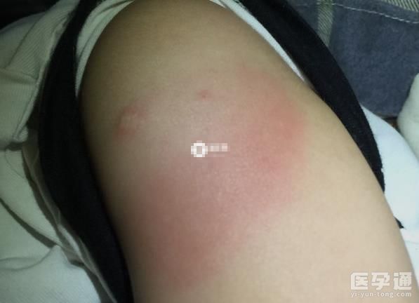 为啥说打百白破第三针很可怕？皆因4大副作用太罕见！