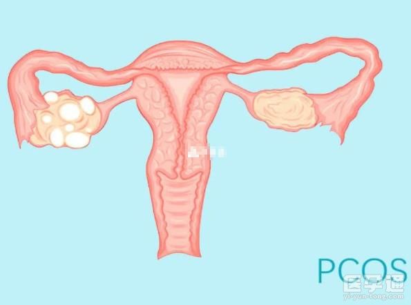 多囊卵巢早期症状揭秘！月经紊乱、肥胖别再视而不见了！