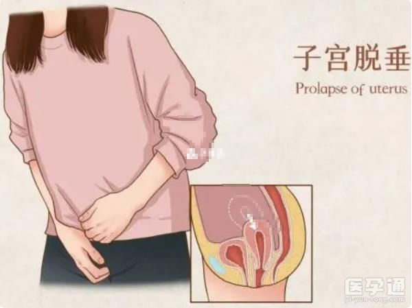 子宫脱垂症状及图片分享，性欲减退、排泄困难者需注意！
