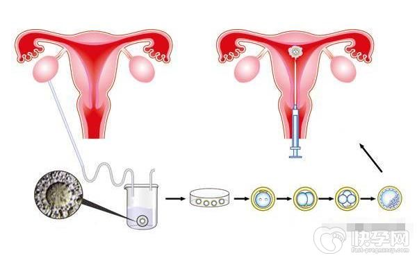 单身男性试管婴儿合法国家所需费用分别是多少？