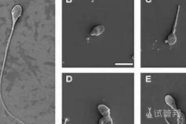 老公弱精症，选择在邵阳市中心医院做试管婴儿