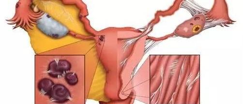 为什么会宫腔粘连？症状有哪些？