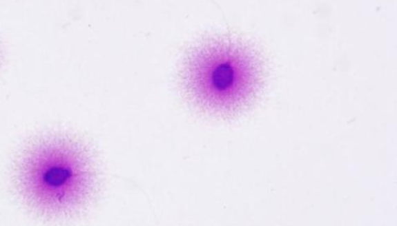 备孕迟迟怀不上，不能忽略了男性精子dna碎片率