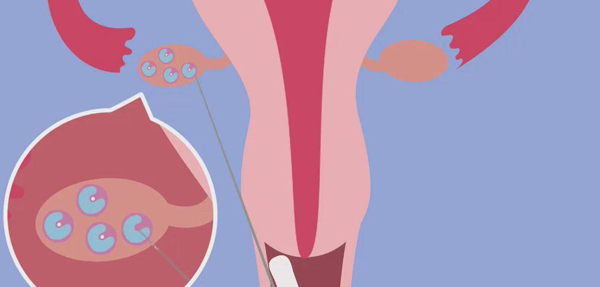 试管备孕女性需知:术前术后4点注意事项需谨记