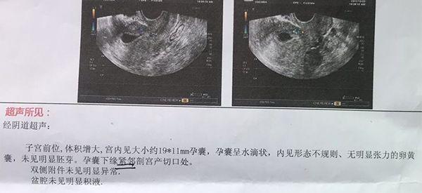 怀孕前3个月b超单上有哪个数字一般怀的是女孩？