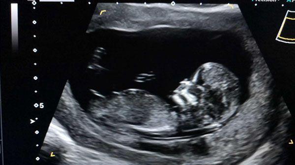 nt值为3.9mm时胎儿畸形概率分析，心脏异常不可忽视