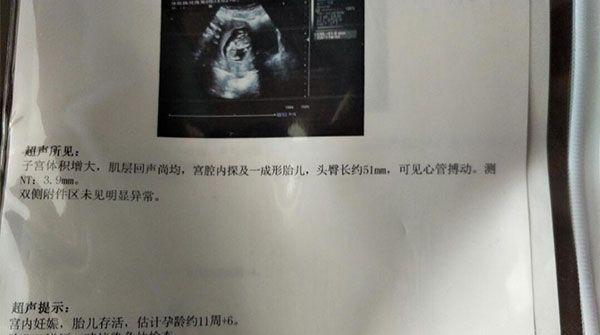 nt值为4.4mm时很危险，及时羊穿确认胎儿畸形很重要