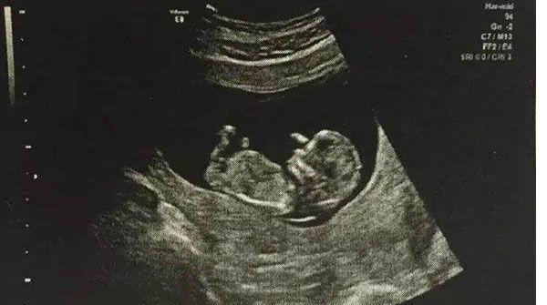 nt检查结果为2.6mm不要慌，偏大也不一定畸形