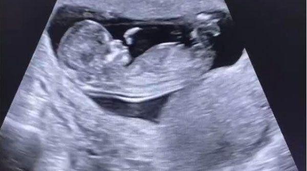 NT检查结果为2.3mm虽正常，但无创DNA还是要做