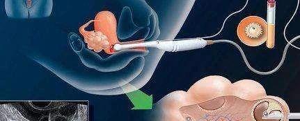 监测卵泡是B超还是阴超？阴道超声和腹部超声的区别不止探头