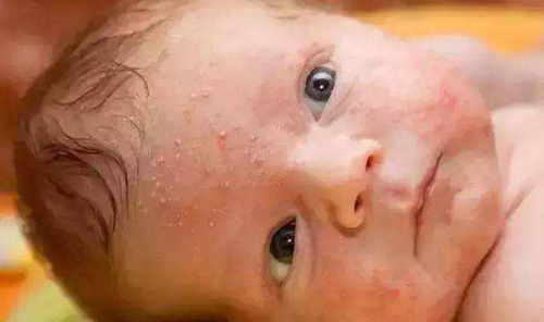 药物过敏疹与病毒疹区别,病毒感染埃可病毒疹其中之一