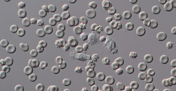 白细胞偏高是怎么回事?大多与这6种原因脱不了干系