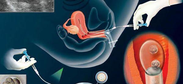 冻胚移植前30分钟用阿托西班的好处多吗？