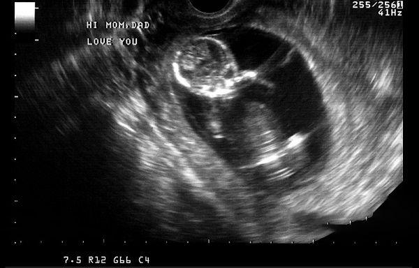 胎儿在腹中打嗝代表什么，位置判断图解能解答吗？