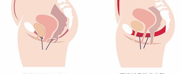 22岁没生过孩子有可能子宫脱垂吗?
