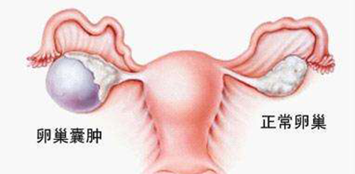 巧克力囊肿试管婴儿助孕应先治疗？网友看法均有差异