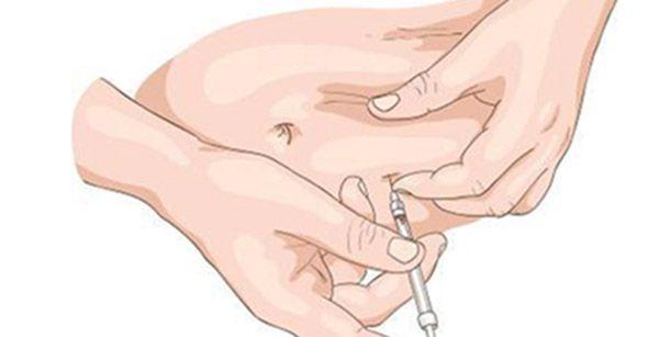 曲普瑞林5步完成自己注射，具体打在哪个部位可以学一学