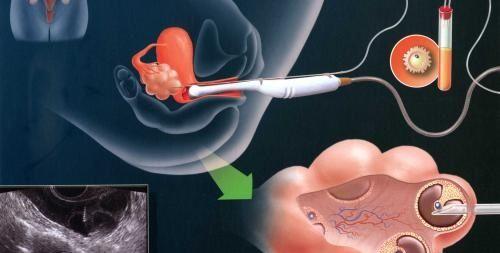 从促排到移植，2022年美国试管婴儿一图看懂全过程