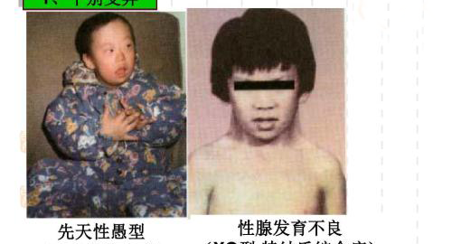 特纳综合症患者长什么样，有真人图片参考吗？