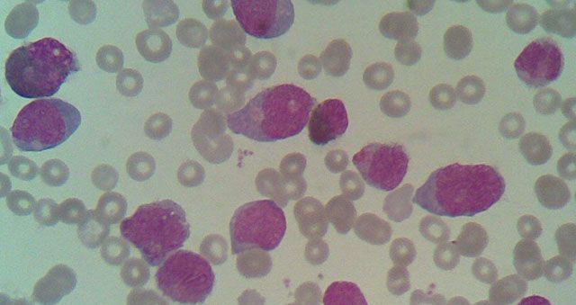 核心结合因子相关急性髓系白血病(CBF-AML)严重么？