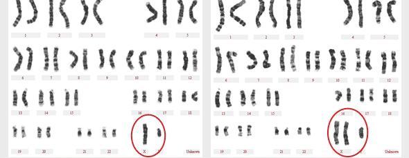 了解“克氏综合征”，不要绝望他不是什么绝症