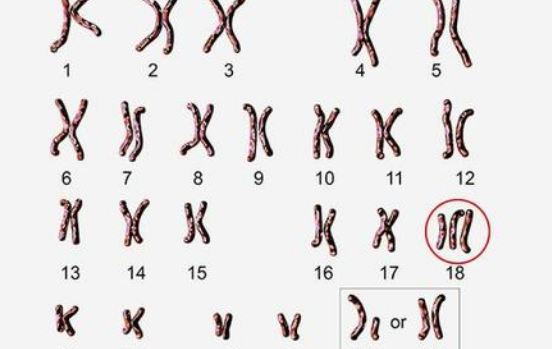 唐筛不能少的环节，来看看什么是易位唐氏综合症？