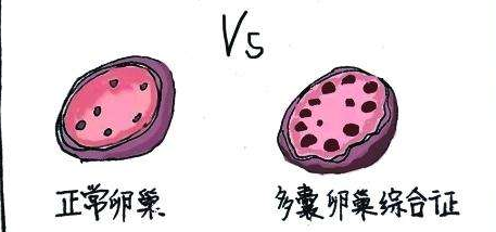 多囊卵巢没那么可怕，日常饮食禁忌这样就对了！