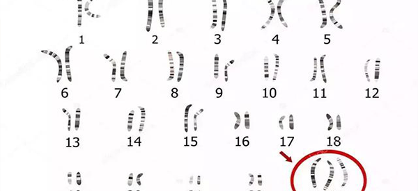 女性染色体异常为47xxx可以正常生孩子吗？