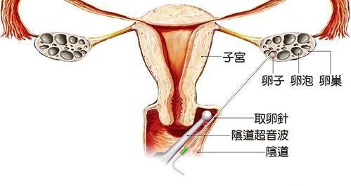 做试管取多少个卵合适,有没有1个卵泡成功的？
