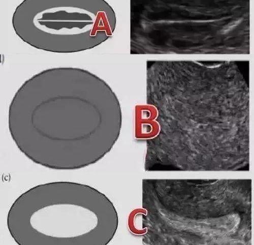 又怕薄、又怕厚，到底什么样的子宫内膜才能留住胚胎？