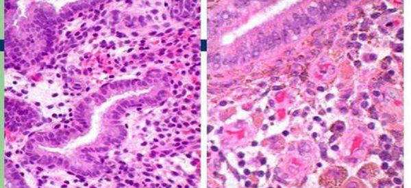 免疫缺陷引起的内膜异位做试管更容易成功吗？