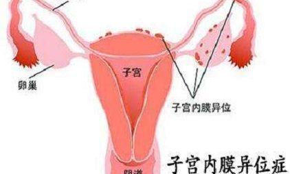 子宫内膜异位怀不了孕怎么办？