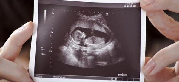 nt厚度正常为什么要强调胎儿有鼻骨？