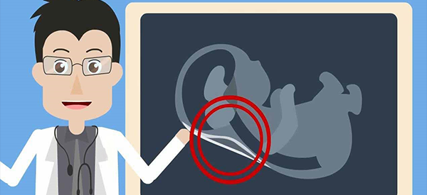 怀孕14周胎儿nt厚度为3mm最后都是正常的吗？